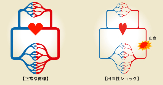 出血性ショック 関連疾患 一般社団法人日本血液製剤協会