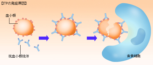 特発性血小板減少性紫斑病（ITP）の発生原因
