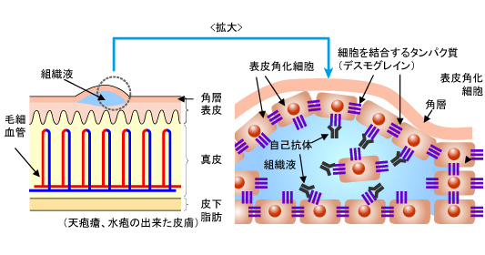 疾患 原因 免疫 自己