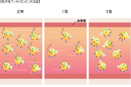 【先天性アンチトロンビン】