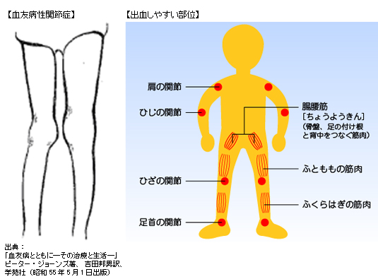 血友病性関節症、出血しやすい部位