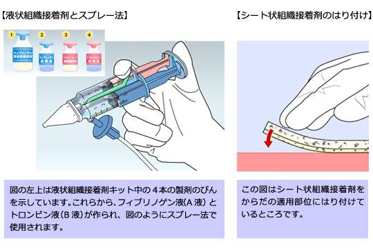 液状接着剤とスプレー法、シート状組織接着剤のはり付け