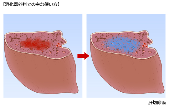 （４）消化器外科での主な使い方