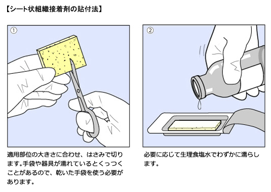 シート状組織接着剤の貼付法-①②