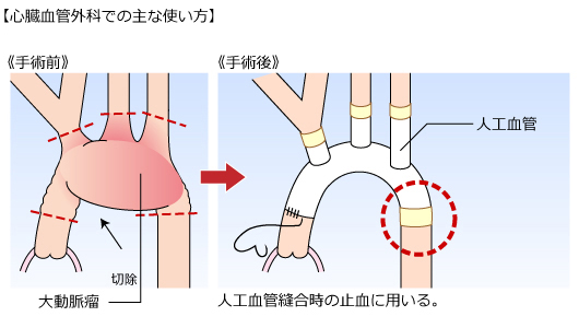 （２）心臓血管外科での主な使い方