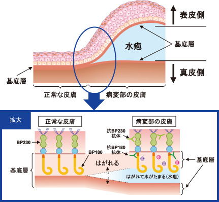 バレー 症候群 うつる ギラン 【患者体験談】食中毒から「ギラン・バレー症候群」に