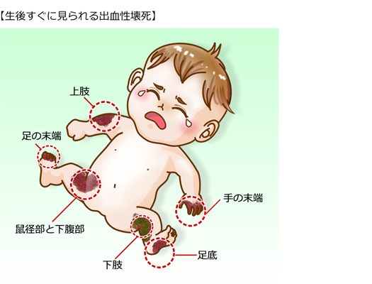 紫斑 病 電撃