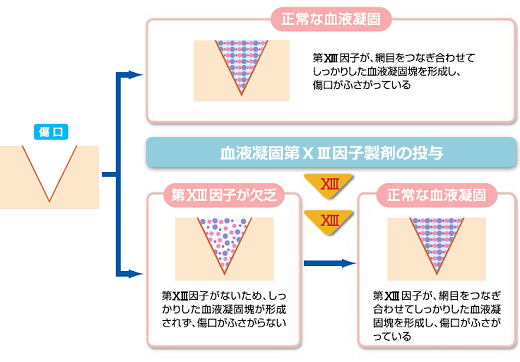 血液凝固第ⅩⅢ因子製剤の作用